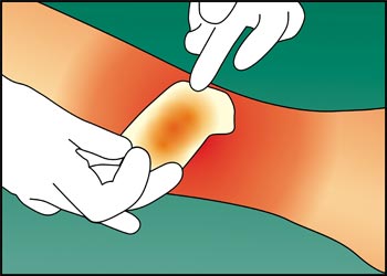 Hyiodine - natürliche Wundbehandlung